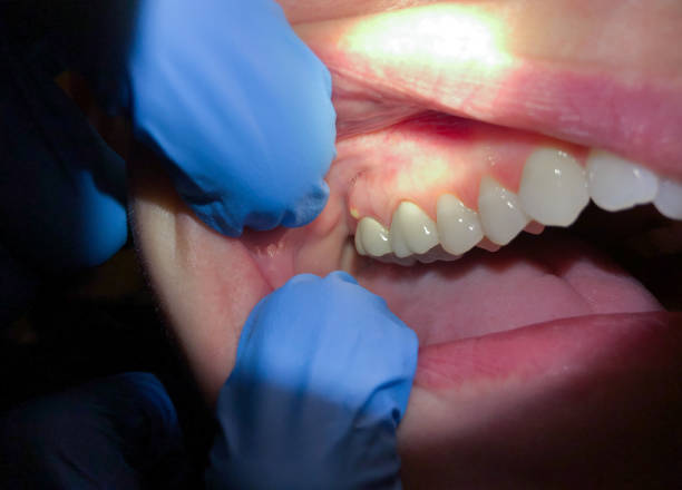 Best Emergency Wisdom Teeth Removal in Richmond, MN